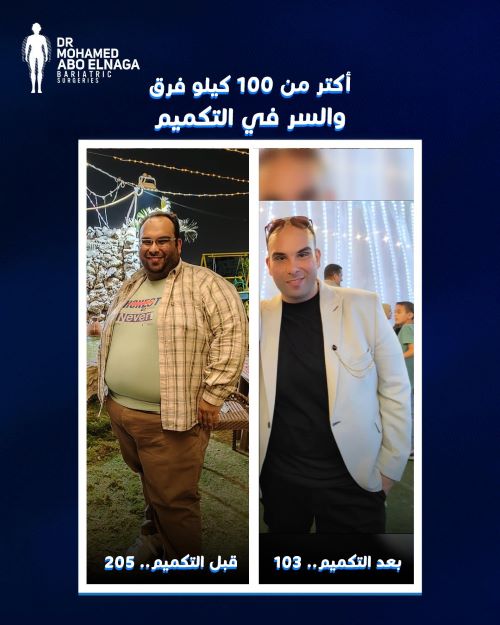 مميزات تكميم المعدة